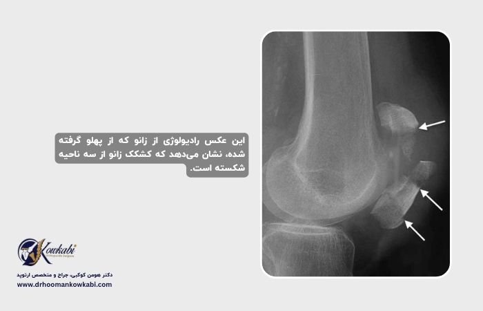 شکستگی‌های کشکک زانو