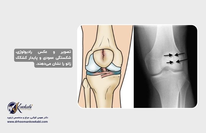 شکستگی‌های کشکک زانو