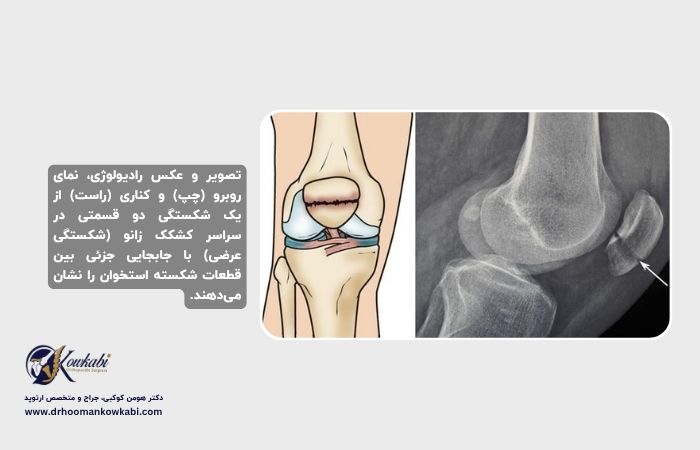 شکستگی‌های کشکک زانو