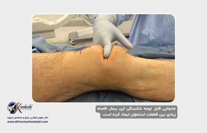 شکستگی‌های کشکک زانو