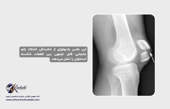 شکستگی‌های کشکک زانو