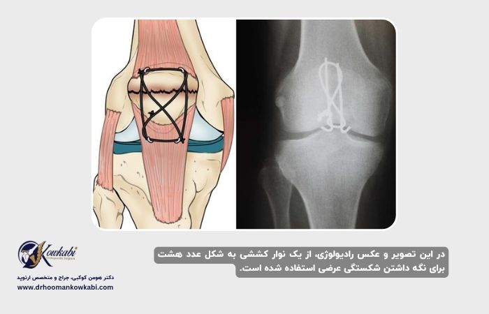 شکستگی‌های کشکک زانو