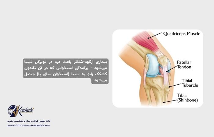 بیماری ازگود شلاتر (درد زانو) ازگود شلاتر
