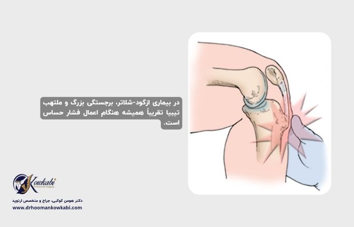 بیماری ازگود شلاتر (درد زانو) ازگود شلاتر