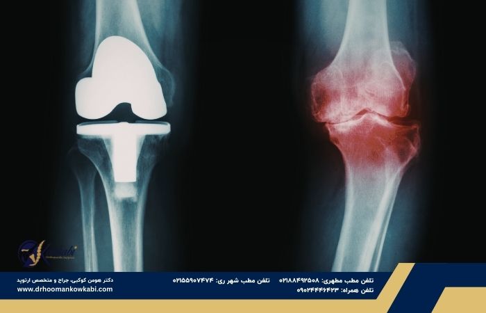 آیا تعویض مفصل زانو عمل خطرناکی است؟ دغدغه درباره تعویض مفصل زانو