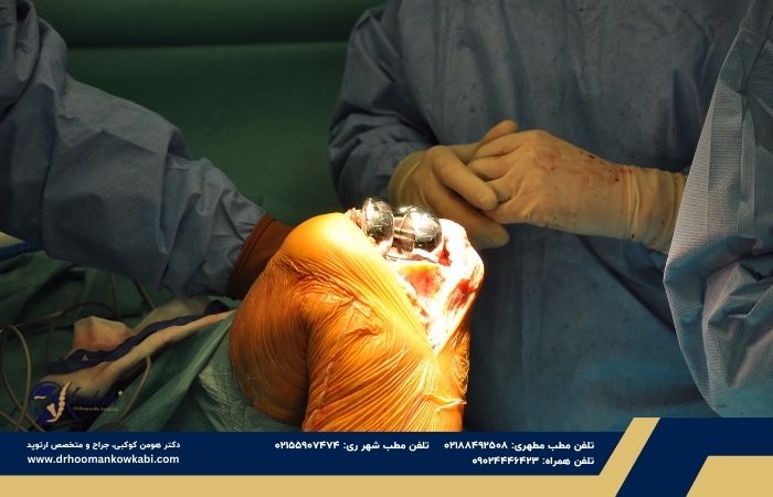 تصمیم‌گیری برای تعویض مفصل زانو