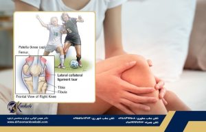 پارگی رباط جانبی خارجی (LCL)