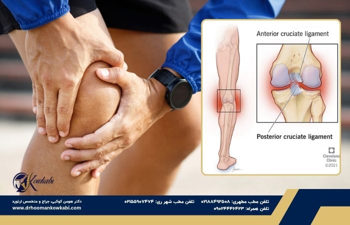 آسیب رباط صلیبی خلفی PCL