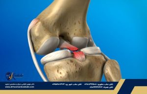 آسیب رباط صلیبی خلفی