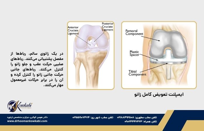 ایمپلنتهای تعویض زانو ایمپلنتهای تعویض زانو