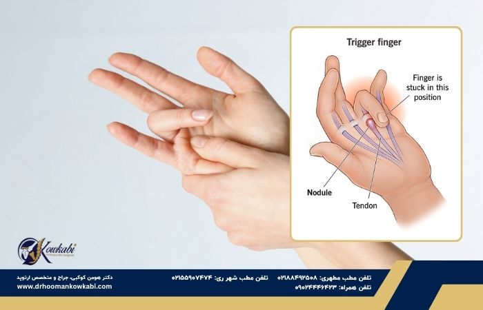 انگشت ماشه‌ای