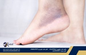 پیچ خوردن مچ پا