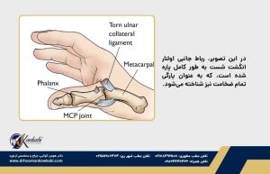 پیچ‌خوردگی انگشت شست