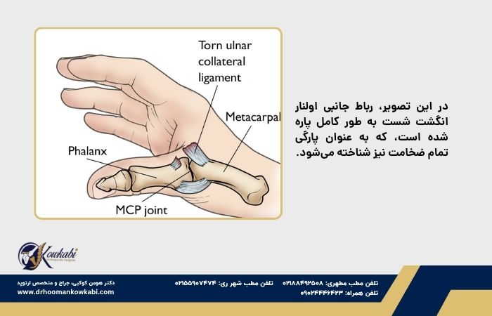 پیچ‌خوردگی انگشت شست
