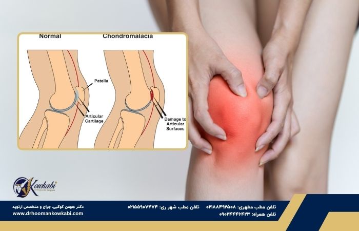 کندرومالاسی کشکک زانو کندرومالاسی کشکک زانو