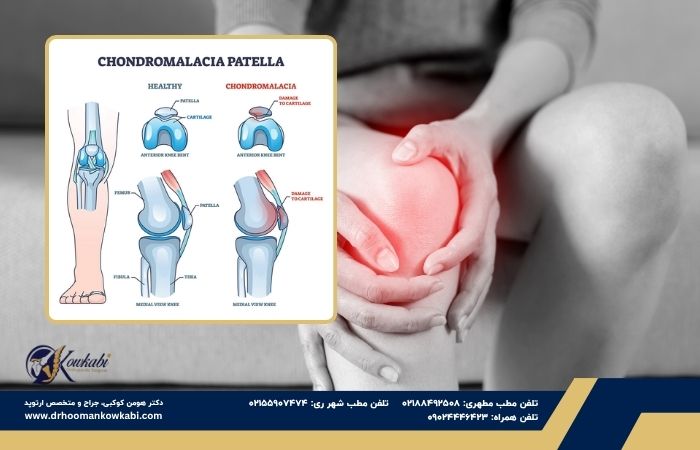 کندرومالاسی کشکک زانو کندرومالاسی کشکک زانو