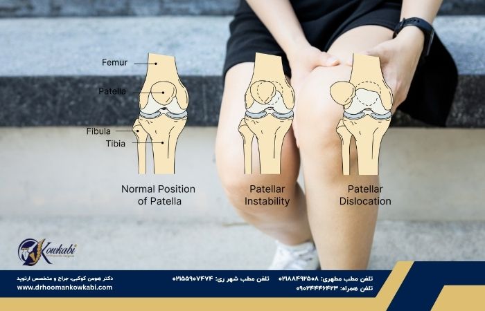 بیثباتی کشکک زانو چیست؟ بیثباتی کشکک زانو