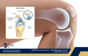 بیثباتی کشکک زانو