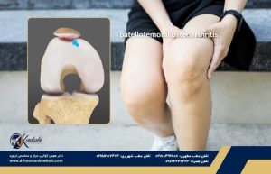آرتروز پاتلوفمورال