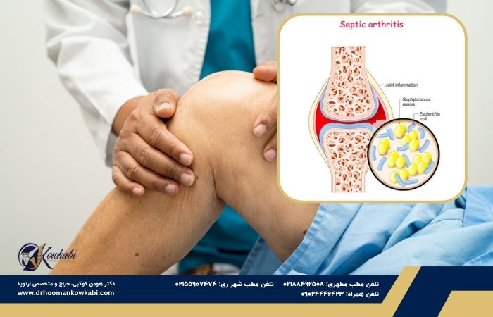 آرتریت سپتیک
