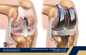 دکتر هومن کوکبی - متخصص ارتوپد تهران تعویض کامل مفصل زانو به روش کم تهاجمی
