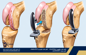تعویض جزئی مفصل زانو چیست؟
